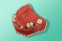 Szczęka ze śluzówką częściowo bezzębna 10-5075