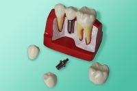 Powiększony demonstracyjny model zębów i implantu 40-0001